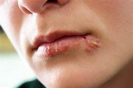 www.reconectandoconlavida.com -herpes labial